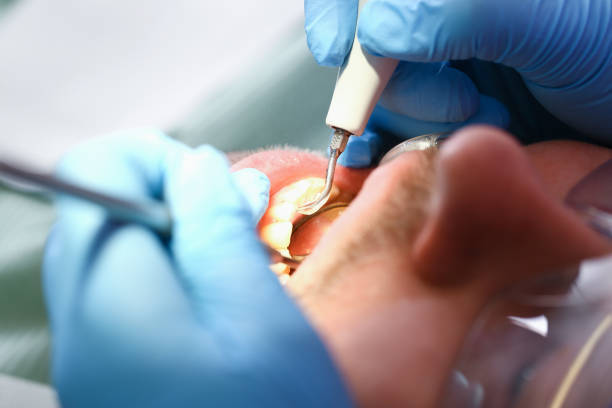Best Emergency Wisdom Teeth Removal in Clover, SC